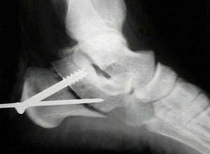 X-ray view of a calcaneal osteotomy from Wheeless’ Textbook of Orthopedics. (photo courtesy www.wheelessonline.com)